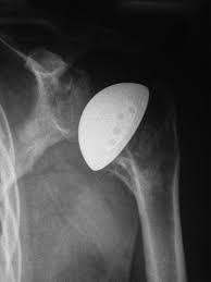 What Is Shoulder Arthritis Dr Roger Chams