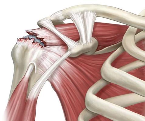 Rotator Cuff Tears - Dr. Roger Chams