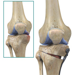 Knee Arthritis - Dr. Roger Chams