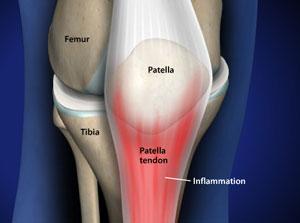 Tendinitis in the Knee