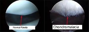 What is Chondromalacia Patella? - Dr. Roger Chams