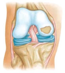 What Is Osteochondritis Dissecans Knee Surgery Dr Roger Chams