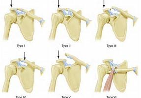 What is an AC Sprain? - Dr. Roger Chams