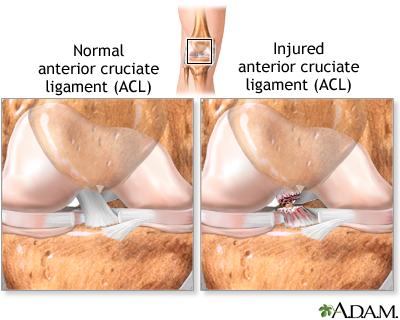 anterior cruciate ligament reconstruction surgery