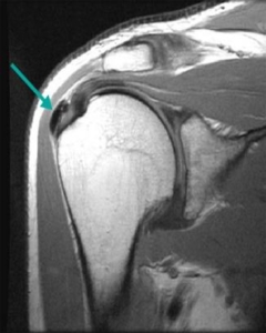 Shoulder Calcific Tendonitis Specialists | Dr. Roger Chams