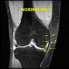 MCL Tear Symptoms and LCL Injuries | Knee Ligament Pain | Dr. Chams