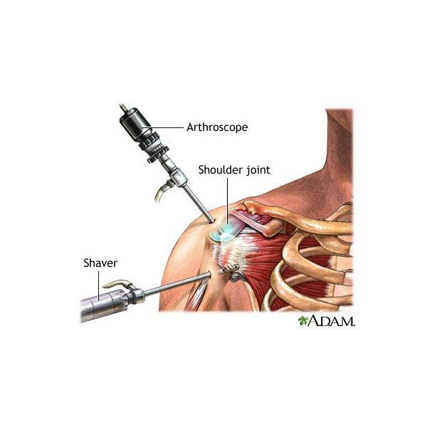 Shoulder Calcific Tendonitis Specialists Dr Roger Chams 7772